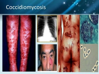 mycosis systemic