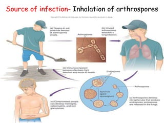 Source of infection- Inhalation of arthrospores
 