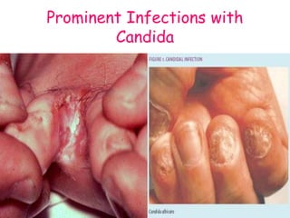 Prominent Infections with
Candida
 