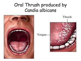 Oral Thrush produced by
Candia albicans
 
