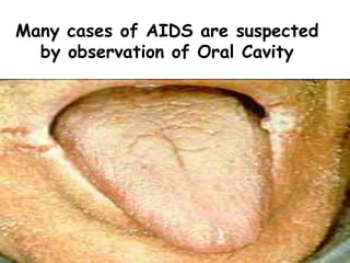 Many cases of AIDS are suspected
by observation of Oral Cavity
 