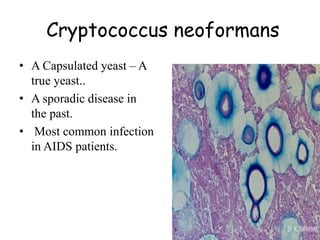 Cryptococcus neoformans
• A Capsulated yeast – A
true yeast..
• A sporadic disease in
the past.
• Most common infection
in AIDS patients.
 