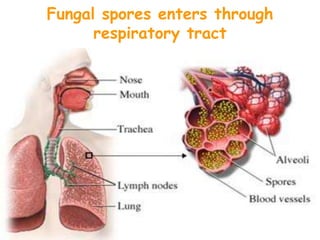 Fungal spores enters through
respiratory tract
 