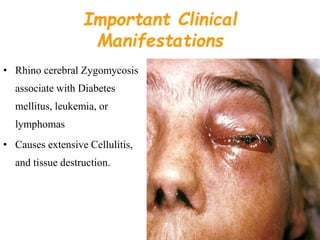 Important Clinical
Manifestations
• Rhino cerebral Zygomycosis
associate with Diabetes
mellitus, leukemia, or
lymphomas
• Causes extensive Cellulitis,
and tissue destruction.
 