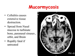Mucormycosis
• Cellulitis causes
extensive tissue
destruction.
• Spread from Nasal
mucosa to turbinate
bone, paranasal sinuses ,
orbit, and Brain
• Rapdily fatal if
untreated
 