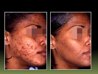 Retinoid Rash Systemic retinoids in dermatology | PPTX