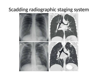 Scadding Radiological Classification systemic sarcoidosis- A multisystem disorder | PPTX