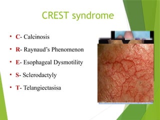 CREST syndrome
• C- Calcinosis
• R- Raynaud’s Phenomenon
• E- Esophageal Dysmotility
• S- Sclerodactyly
• T- Telangiectasisa
 