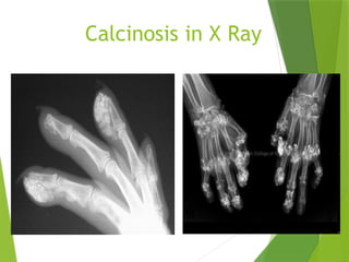 Calcinosis in X Ray
 