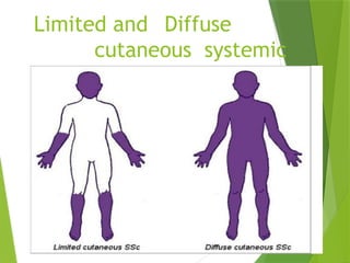 Limited and Diffuse
cutaneous systemic
sclerosis
 