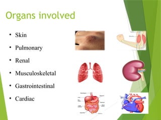 Organs involved
• Skin
• Pulmonary
• Renal
• Musculoskeletal
• Gastrointestinal
• Cardiac
 