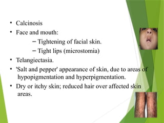 • Calcinosis
• Face and mouth:
– Tightening of facial skin.
– Tight lips (microstomia)
• Telangiectasia.
• 'Salt and pepper' appearance of skin, due to areas of
hypopigmentation and hyperpigmentation.
• Dry or itchy skin; reduced hair over affected skin
areas.
 