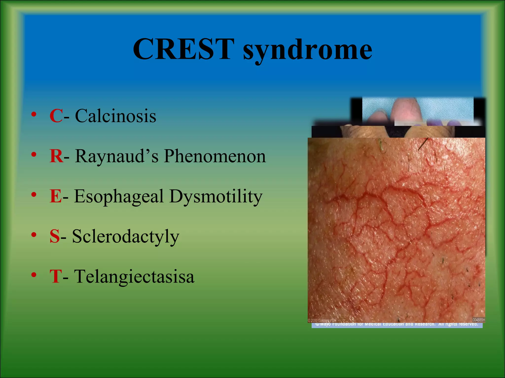 CREST syndrome
• C- Calcinosis
• R- Raynaud’s Phenomenon
• E- Esophageal Dysmotility
• S- Sclerodactyly
• T- Telangiectasisa
 