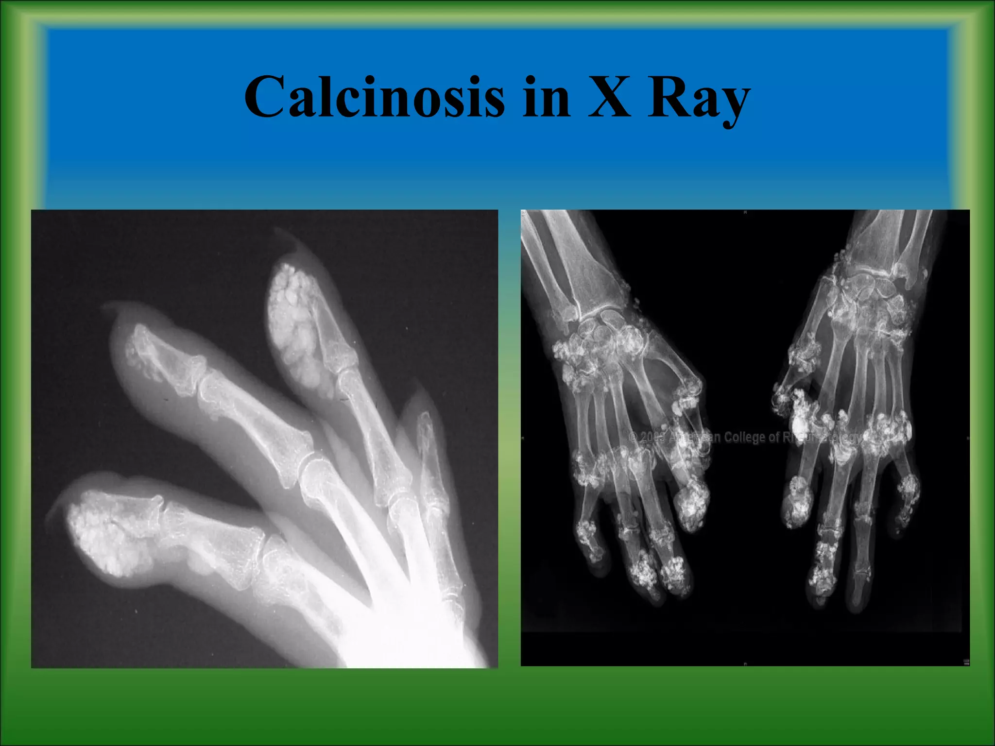 Calcinosis in X Ray
 
