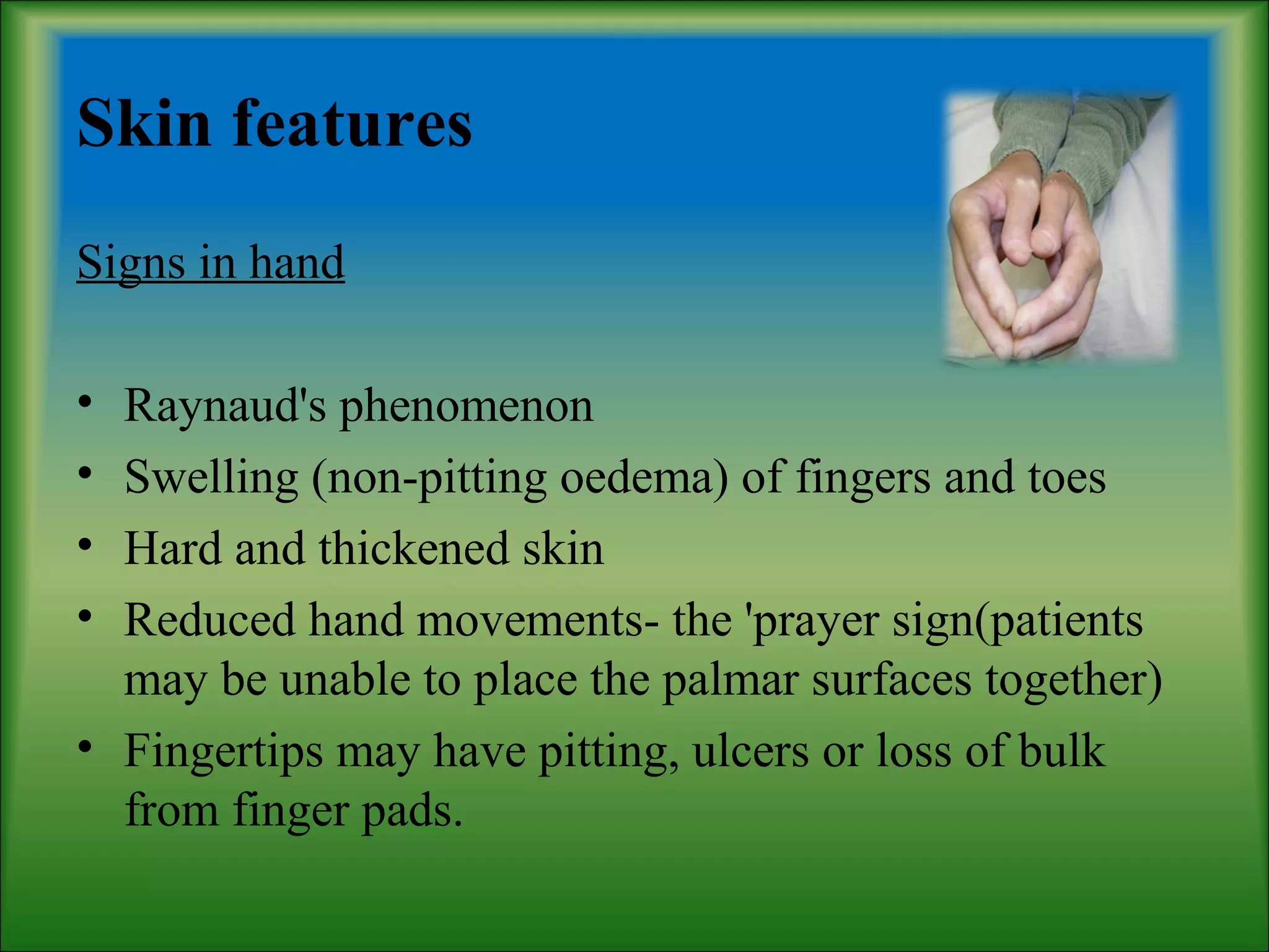 Skin features
Signs in hand
• Raynaud's phenomenon
• Swelling (non-pitting oedema) of fingers and toes
• Hard and thickened skin
• Reduced hand movements- the 'prayer sign(patients
may be unable to place the palmar surfaces together)
• Fingertips may have pitting, ulcers or loss of bulk
from finger pads.
 