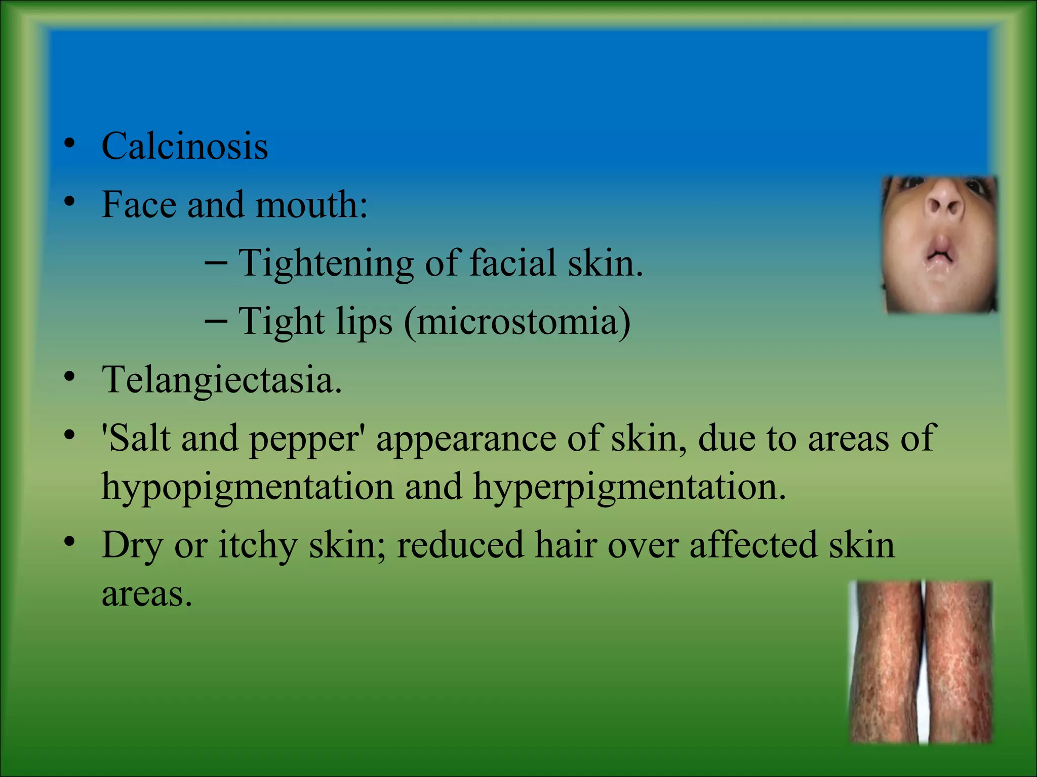 • Calcinosis
• Face and mouth:
– Tightening of facial skin.
– Tight lips (microstomia)
• Telangiectasia.
• 'Salt and pepper' appearance of skin, due to areas of
hypopigmentation and hyperpigmentation.
• Dry or itchy skin; reduced hair over affected skin
areas.
 