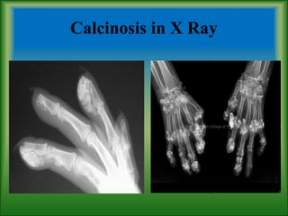 Calcinosis in X Ray
 