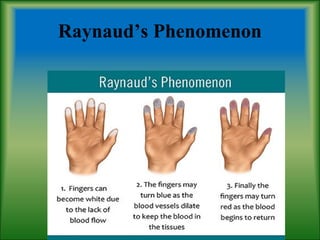 Raynaud’s Phenomenon
 