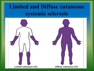 Limited and Diffuse cutaneous
systemic sclerosis
 