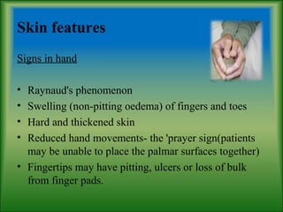 Skin features
Signs in hand
• Raynaud's phenomenon
• Swelling (non-pitting oedema) of fingers and toes
• Hard and thickened skin
• Reduced hand movements- the 'prayer sign(patients
may be unable to place the palmar surfaces together)
• Fingertips may have pitting, ulcers or loss of bulk
from finger pads.
 