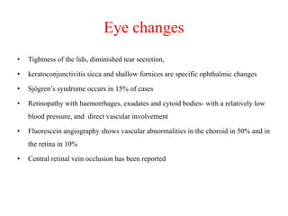 Eye changes
• Tightness of the lids, diminished tear secretion,
• keratoconjunctivitis sicca and shallow fornices are specific ophthalmic changes
• Sjögren’s syndrome occurs in 15% of cases
• Retinopathy with haemorrhages, exudates and cytoid bodies- with a relatively low
blood pressure, and direct vascular involvement
• Fluorescein angiography shows vascular abnormalities in the choroid in 50% and in
the retina in 10%
• Central retinal vein occlusion has been reported
 
