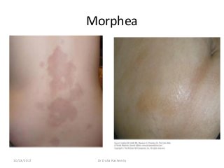 Morphea
10/23/2017 Dr Doha Rasheedy
 
