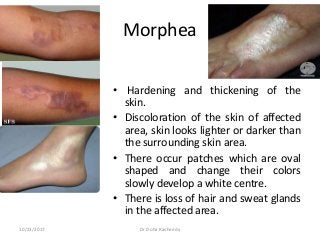 Morphea
• Hardening and thickening of the
skin.
• Discoloration of the skin of affected
area, skin looks lighter or darker than
the surrounding skin area.
• There occur patches which are oval
shaped and change their colors
slowly develop a white centre.
• There is loss of hair and sweat glands
in the affected area.
10/23/2017 Dr Doha Rasheedy
 