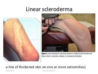 Linear scleroderma
a line of thickened skin on one or more extremities)
10/23/2017 Dr Doha Rasheedy
 