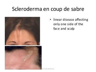 Scleroderma en coup de sabre
• linear disease affecting
only one side of the
face and scalp
10/23/2017 Dr Doha Rasheedy
 