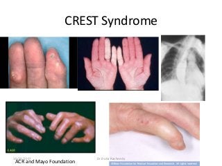 CREST Syndrome
ACR and Mayo Foundation
10/23/2017 Dr Doha Rasheedy
 