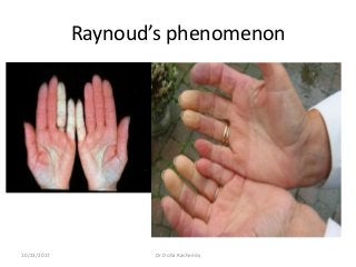 Raynoud’s phenomenon
10/23/2017 Dr Doha Rasheedy
 