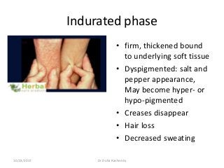 Indurated phase
• firm, thickened bound
to underlying soft tissue
• Dyspigmented: salt and
pepper appearance,
May become hyper- or
hypo-pigmented
• Creases disappear
• Hair loss
• Decreased sweating
10/23/2017 Dr Doha Rasheedy
 
