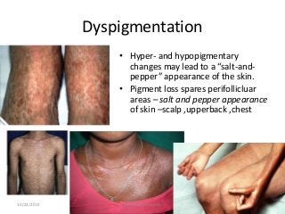 Dyspigmentation
• Hyper- and hypopigmentary
changes may lead to a “salt-and-
pepper” appearance of the skin.
• Pigment loss spares perifollicluar
areas – salt and pepper appearance
of skin –scalp ,upperback ,chest
10/23/2017 Dr Doha Rasheedy
 