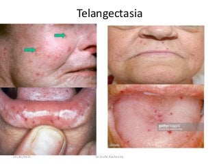 Telangectasia
10/23/2017 Dr Doha Rasheedy
 