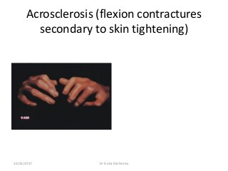 Acrosclerosis (flexion contractures
secondary to skin tightening)
10/23/2017 Dr Doha Rasheedy
 