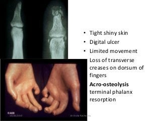 • Tight shiny skin
• Digital ulcer
• Limited movement
• Loss of transverse
creases on dorsum of
fingers
• Acro-osteolysis
terminal phalanx
resorption
10/23/2017 Dr Doha Rasheedy
 