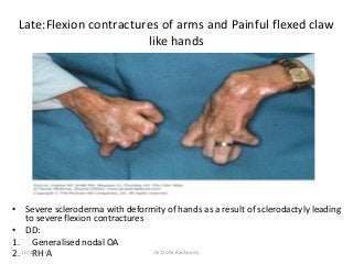 Late:Flexion contractures of arms and Painful flexed claw
like hands
• Severe scleroderma with deformity of hands as a result of sclerodactyly leading
to severe flexion contractures
• DD:
1. Generalised nodal OA
2. RH A10/23/2017 Dr Doha Rasheedy
 