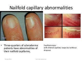 Nailfold capillary abnormalities
• Three-quarters of scleroderma
patients have abnormalities of
their nailfold capillaries,
Capillaroscopy
with dilated capillary loops but without
dropout.
10/23/2017 Dr Doha Rasheedy
 