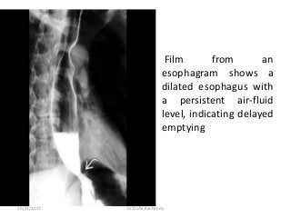 • Film from an
esophagram shows a
dilated esophagus with
a persistent air-fluid
level, indicating delayed
emptying
10/23/2017 Dr Doha Rasheedy
 