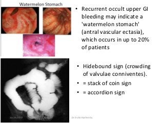 • Recurrent occult upper GI
bleeding may indicate a
'watermelon stomach'
(antral vascular ectasia),
which occurs in up to 20%
of patients
• Hidebound sign (crowding
of valvulae conniventes).
• = stack of coin sign
• = accordion sign
10/23/2017 Dr Doha Rasheedy
 