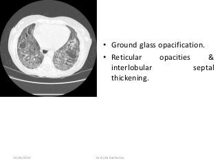• Ground glass opacification.
• Reticular opacities &
interlobular septal
thickening.
10/23/2017 Dr Doha Rasheedy
 