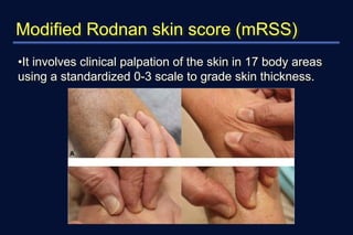 Rodnan Skin Systemic sclerosis Detailed Management and CLINICAL FEATURS | PPTX