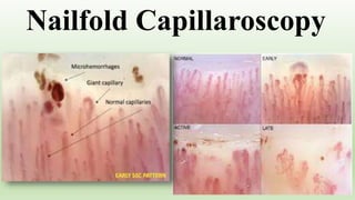 Nailfold Capillaroscopy
 