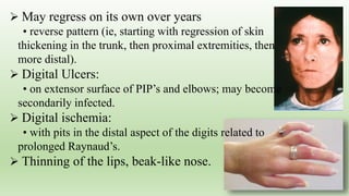  May regress on its own over years
• reverse pattern (ie, starting with regression of skin
thickening in the trunk, then proximal extremities, then
more distal).
 Digital Ulcers:
• on extensor surface of PIP’s and elbows; may become
secondarily infected.
 Digital ischemia:
• with pits in the distal aspect of the digits related to
prolonged Raynaud’s.
 Thinning of the lips, beak-like nose.
 