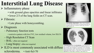  Inflammatory phase
• with ground glass opacities and linear infiltrates
• lower 2/3 of the lung fields on CT scan.
 Fibrosis:
• Late phase with honeycombing.
 Diagnosis
– Pulmonary function tests
• restrictive pattern with low FVC, low residual volume, low DLCO.
– High Resolution CT Scan
– BAL: often not required
– Lung biopsy: often not required
 ILD is most commonly associated with diffuse
scleroderma. • Anti-Scl-70
Interstitial Lung Disease
 