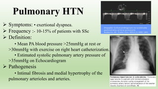  Symptoms: • exertional dyspnea.
 Frequency :- 10-15% of patients with SSc
 Definition:
• Mean PA blood pressure >25mmHg at rest or
>30mmHg with exercise on right heart catheterization.
• Estimated systolic pulmonary artery pressure of
>35mmHg on Echocardiogram
 Pathogenesis
• Intimal fibrosis and medial hypertrophy of the
pulmonary arterioles and arteries.
Pulmonary HTN
 