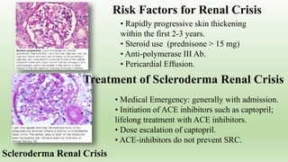 Scleroderma Renal Crisis
Risk Factors for Renal Crisis
• Rapidly progressive skin thickening
within the first 2-3 years.
• Steroid use (prednisone > 15 mg)
• Anti-polymerase III Ab.
• Pericardial Effusion.
Treatment of Scleroderma Renal Crisis
• Medical Emergency: generally with admission.
• Initiation of ACE inhibitors such as captopril;
lifelong treatment with ACE inhibitors.
• Dose escalation of captopril.
• ACE-inhibitors do not prevent SRC.
 