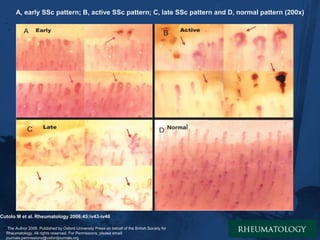 Juvenile onset systemic sclerosis is uncommon.
