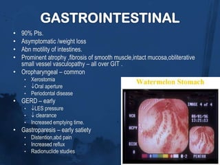 Clinical featuresRAYNAUD’S PHENOMENON:Episodic vasoconstriction  in the fingers and toes.
