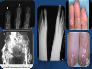   SECONDARY  --complication of SSc…Raynaud’s phenomenonPrimary – no underlying causes 